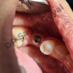 Dental Implant