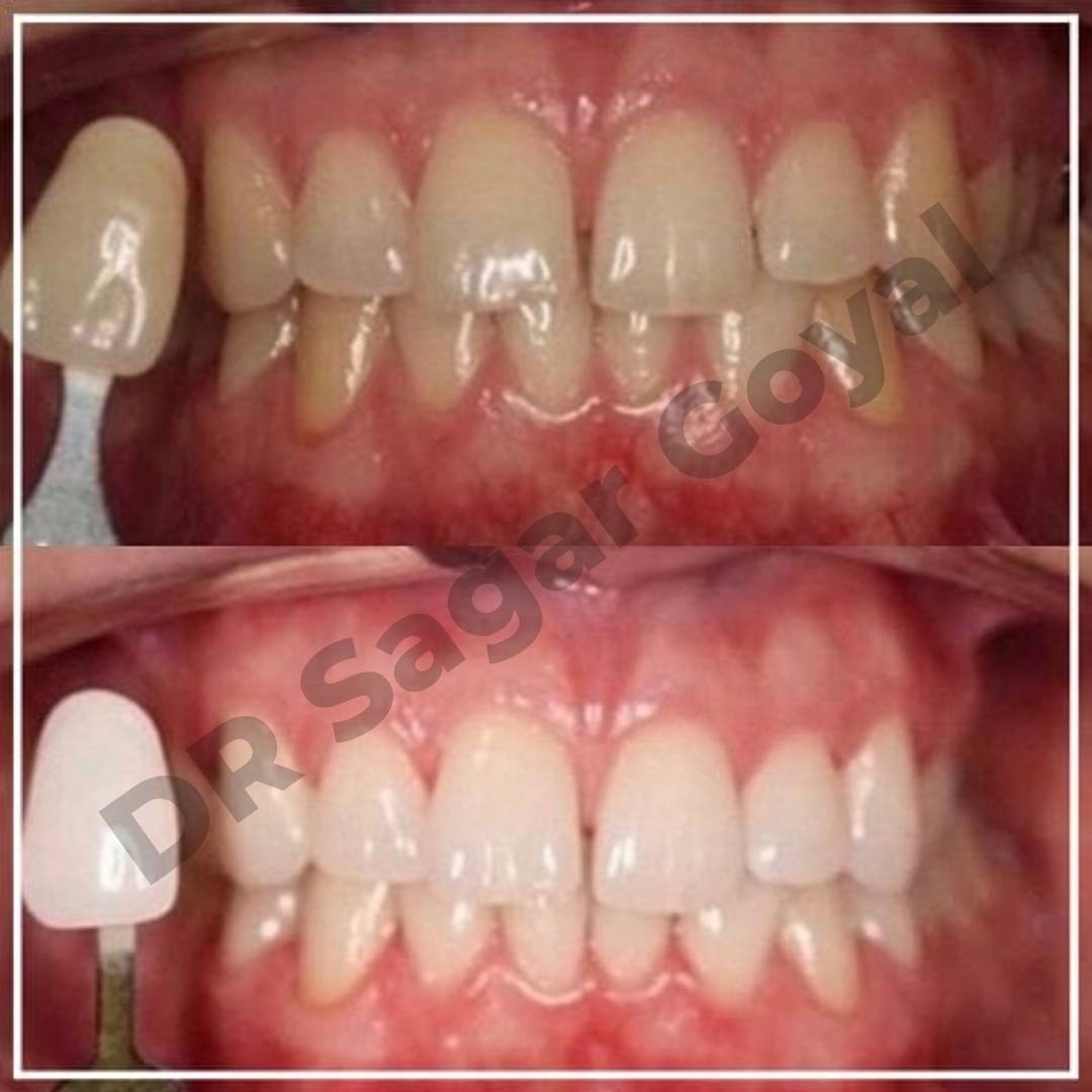 Dr. Sagar Goyal performing best teeth whitening service in Kaithal