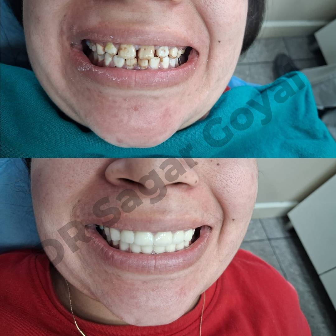 Smile designing service in Kaithal at Goyal Dental Hospital