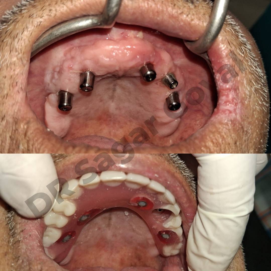 Full mouth rehabilitation service in Kaithal at Goyal Dental Hospital