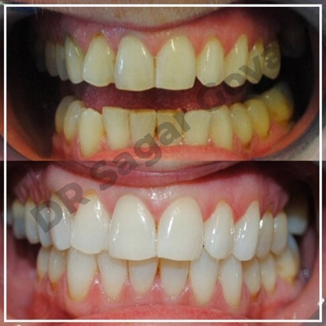 Teeth whitening service Kaithal – Goyal Dental Hospital