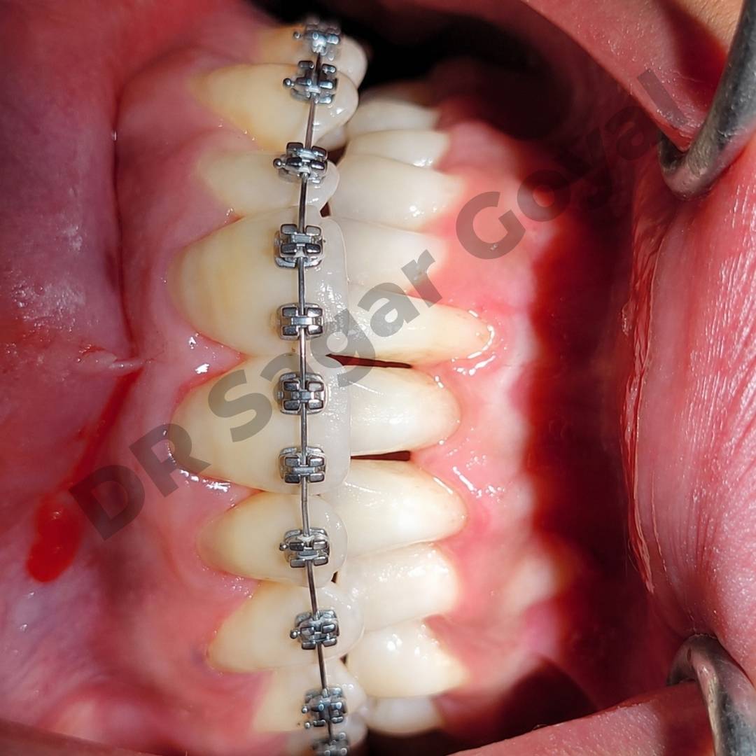 Braces and aligners service Kaithal – Goyal Dental Hospital